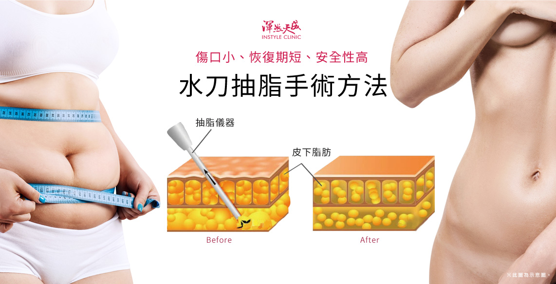 渾然天成整形醫美|水刀抽脂,傷口小、出血量少、安全性高。 渾然天成整形醫美|P水刀抽脂,傷口小、出血量少、安全性高。